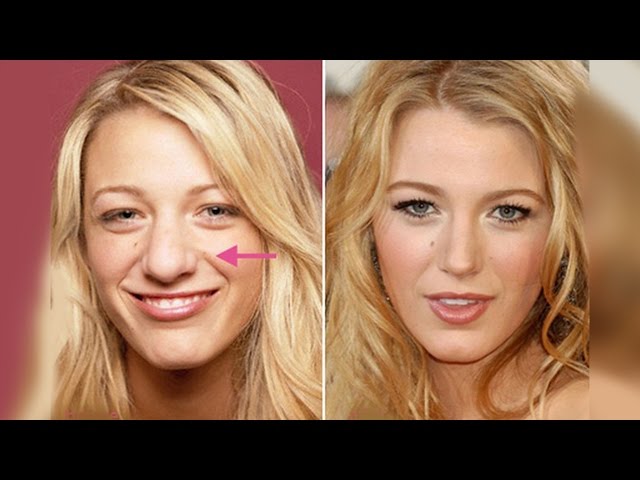 Quick Facts About Blake Lively’s Plastic Surgery Procedures in the Past